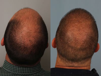 NeoGraft Before & After Gallery - Patient 199856 - Image 1