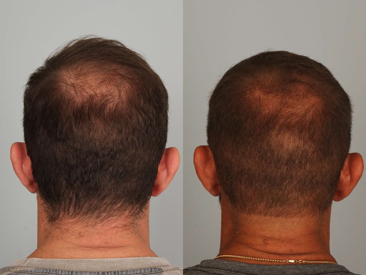NeoGraft Before & After Gallery - Patient 196271 - Image 3