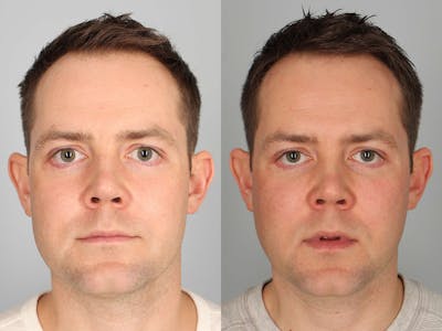 NeoGraft Before & After Gallery - Patient 139555 - Image 1