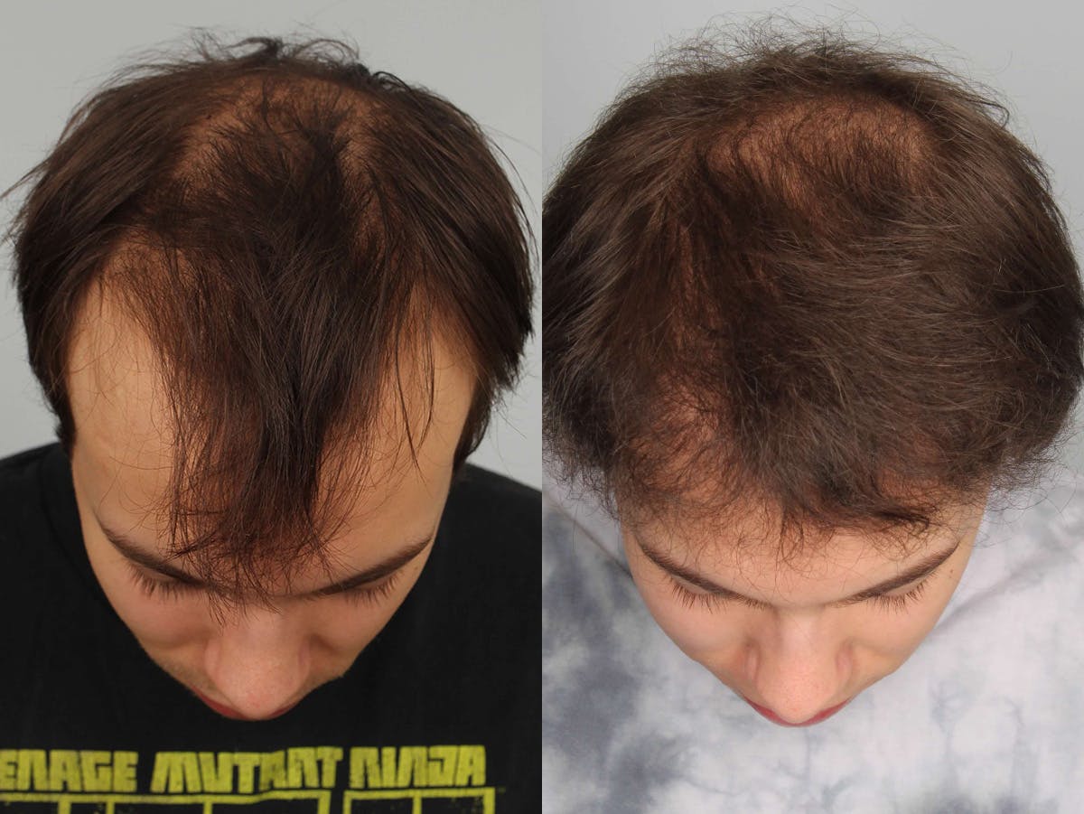 NeoGraft Before & After Gallery - Patient 494883 - Image 2
