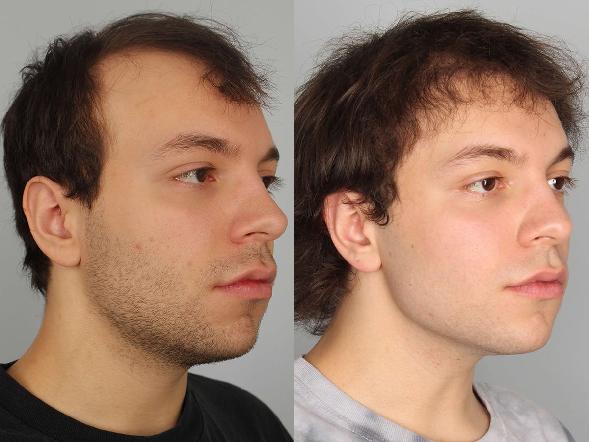 NeoGraft Before & After Gallery - Patient 494883 - Image 1