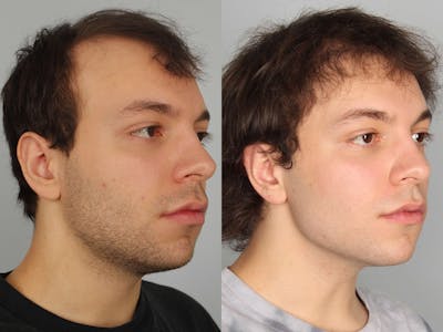 NeoGraft Before & After Gallery - Patient 494883 - Image 1