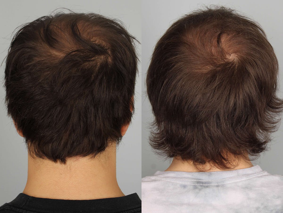 NeoGraft Before & After Gallery - Patient 494883 - Image 3
