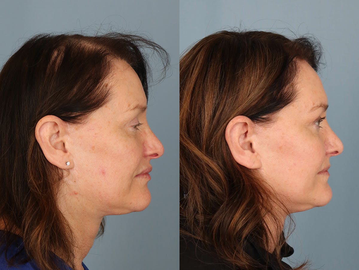 NeoGraft Before & After Gallery - Patient 420190 - Image 3