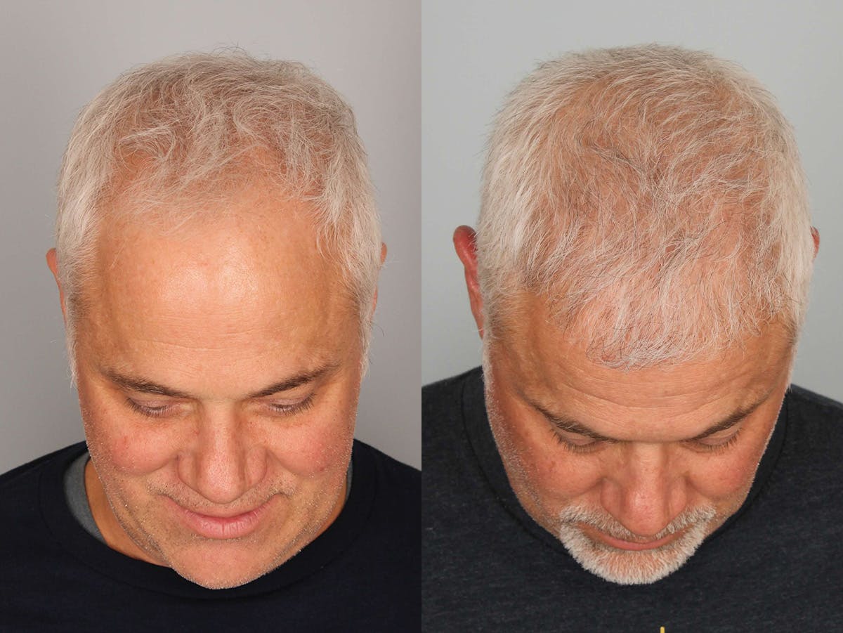 NeoGraft Before & After Gallery - Patient 179777 - Image 1