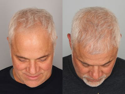 NeoGraft Before & After Gallery - Patient 179777 - Image 1