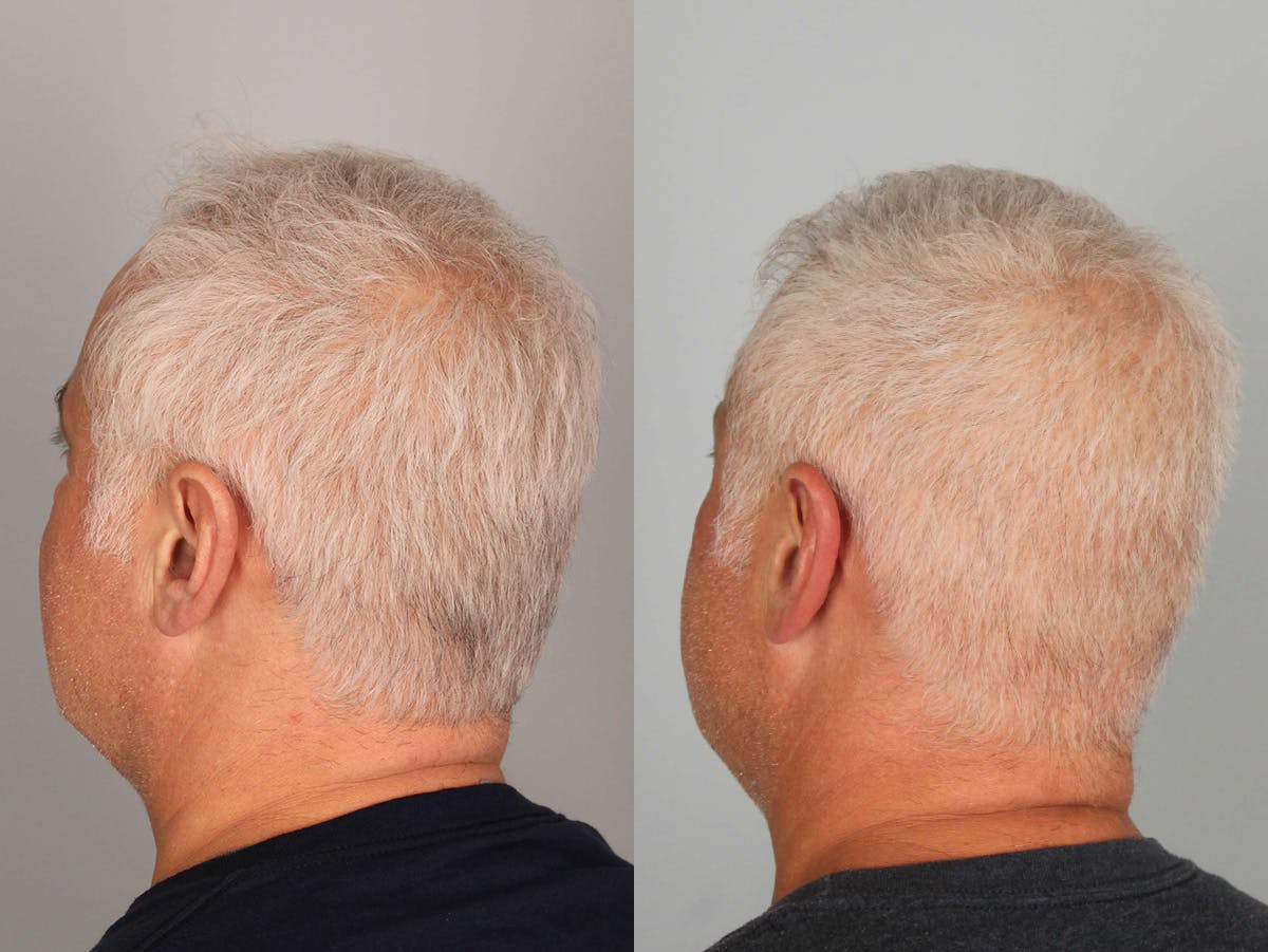 NeoGraft Before & After Gallery - Patient 179777 - Image 3