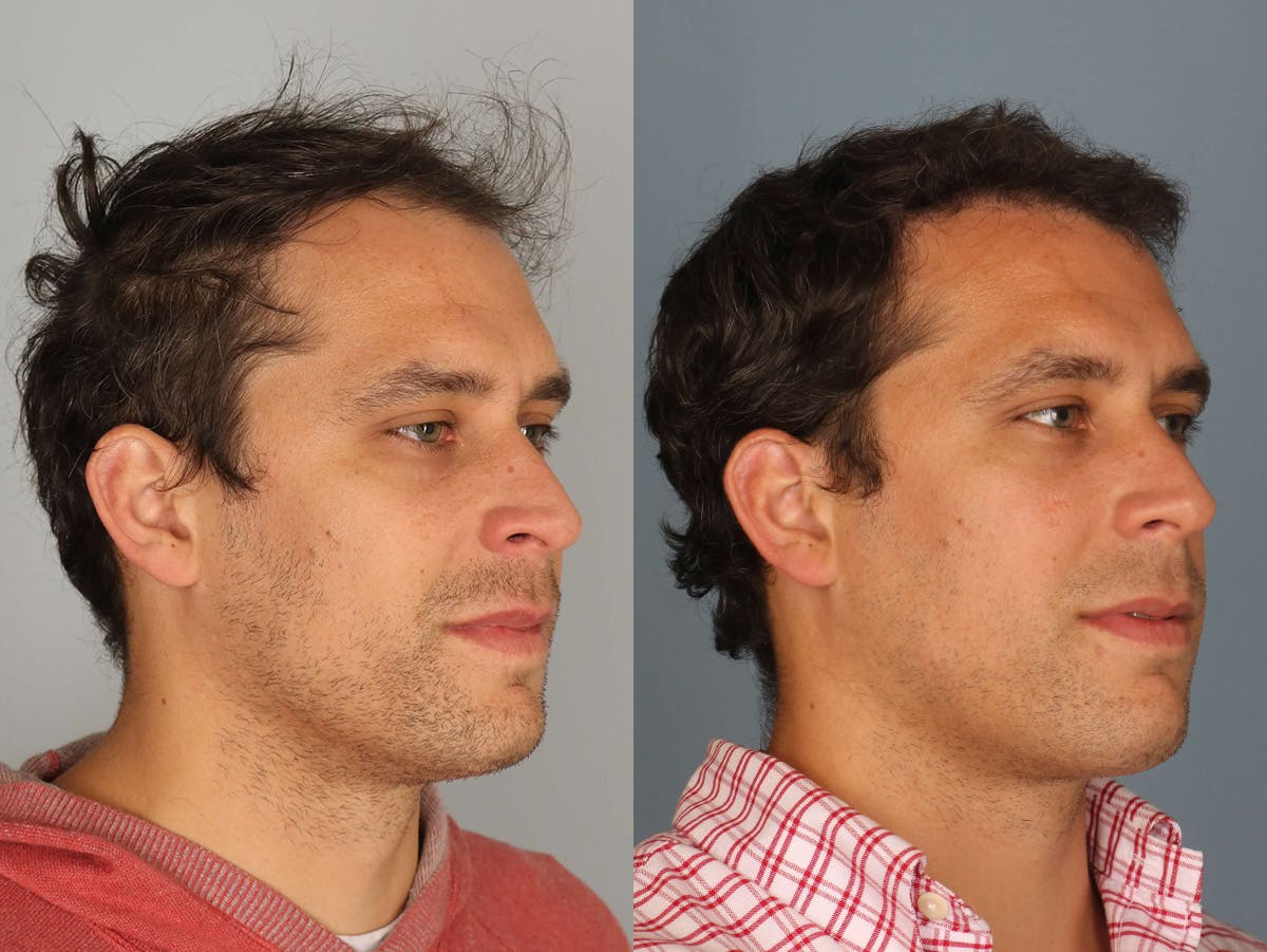 NeoGraft Before & After Gallery - Patient 175288 - Image 2