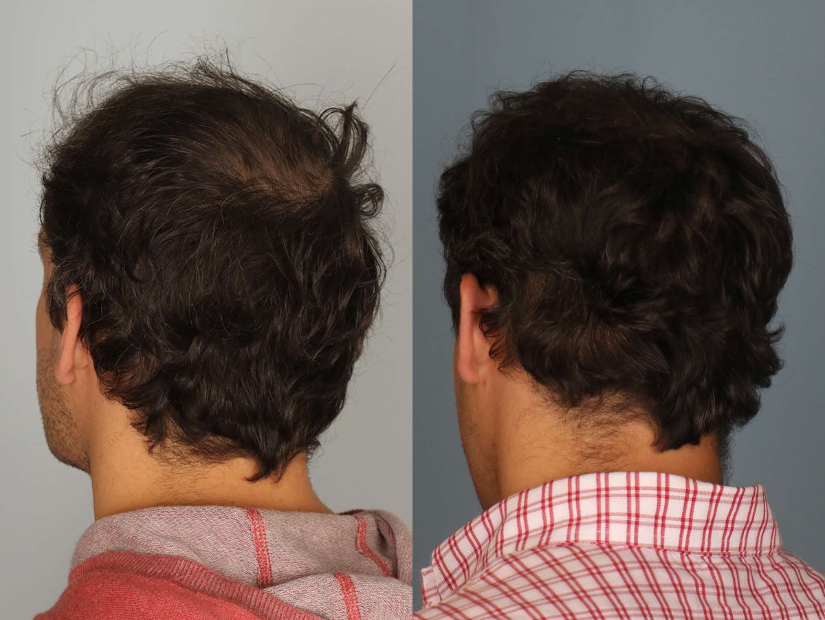 NeoGraft Before & After Gallery - Patient 175288 - Image 3