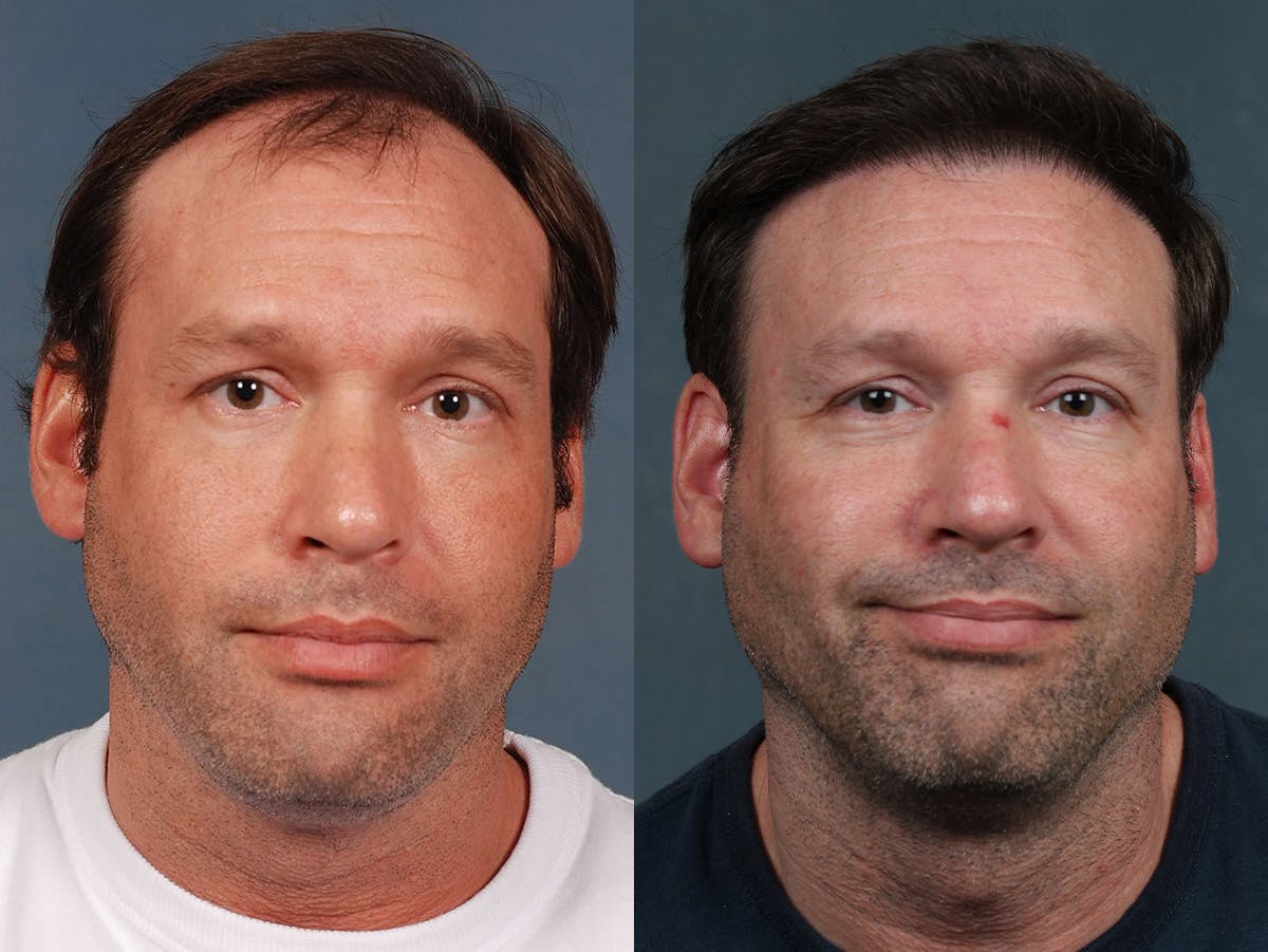 NeoGraft Before & After Gallery - Patient 165186 - Image 1