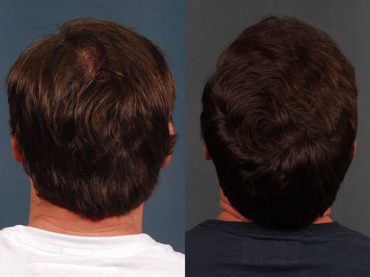 NeoGraft Before & After Gallery - Patient 165186 - Image 3
