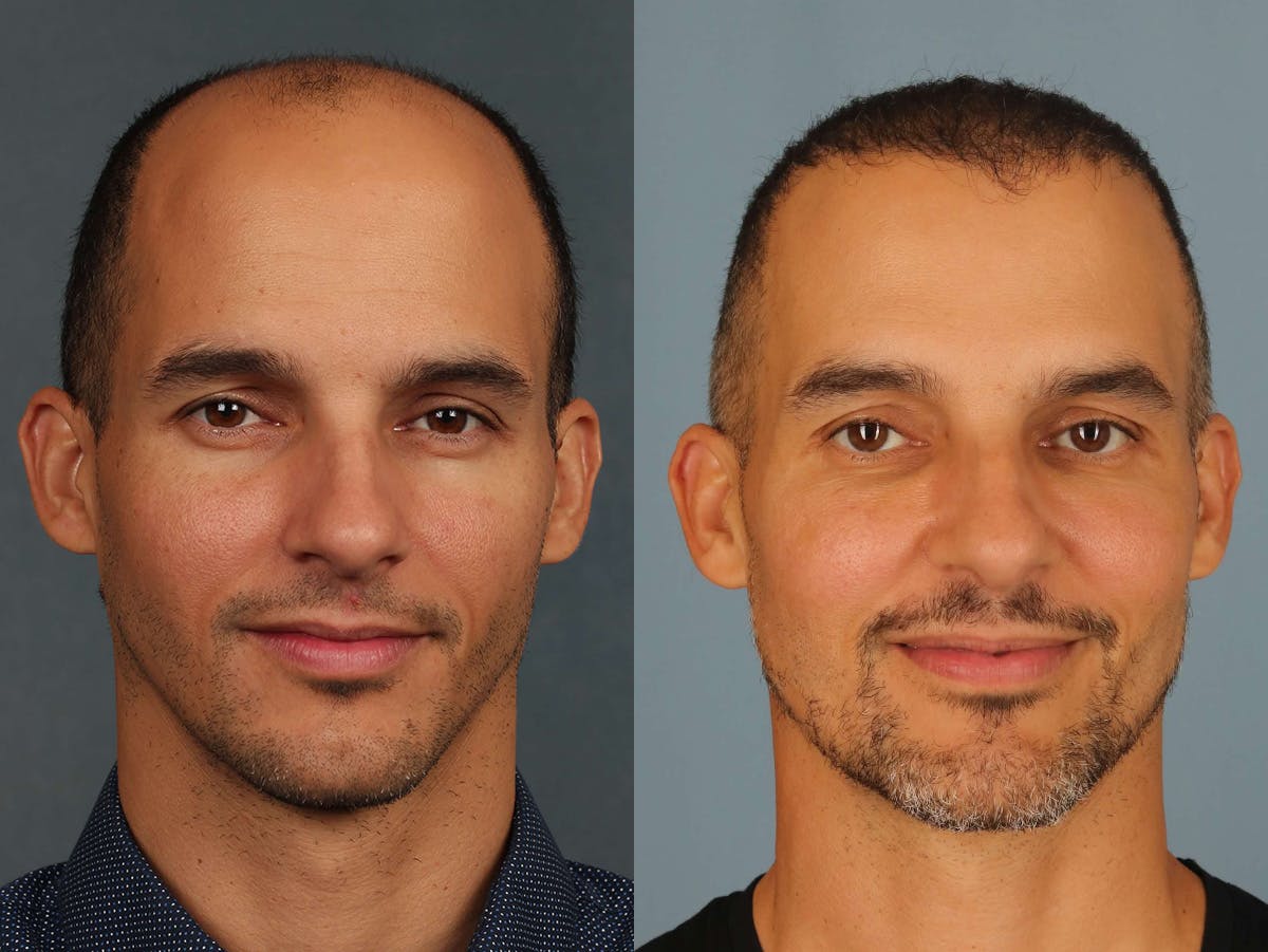 NeoGraft Before & After Gallery - Patient 171850 - Image 1