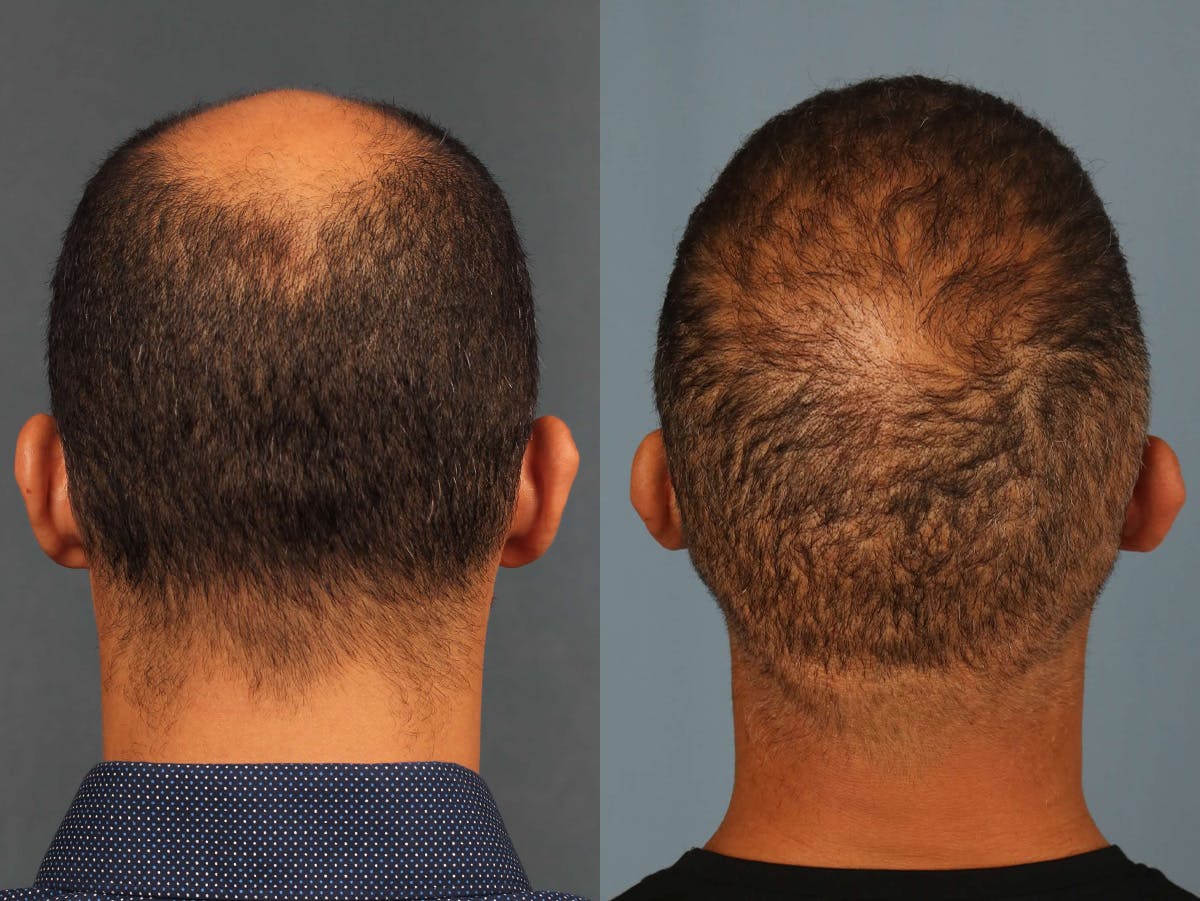 NeoGraft Before & After Gallery - Patient 171850 - Image 3