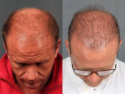 NeoGraft Before & After Gallery - Patient 214978 - Image 1