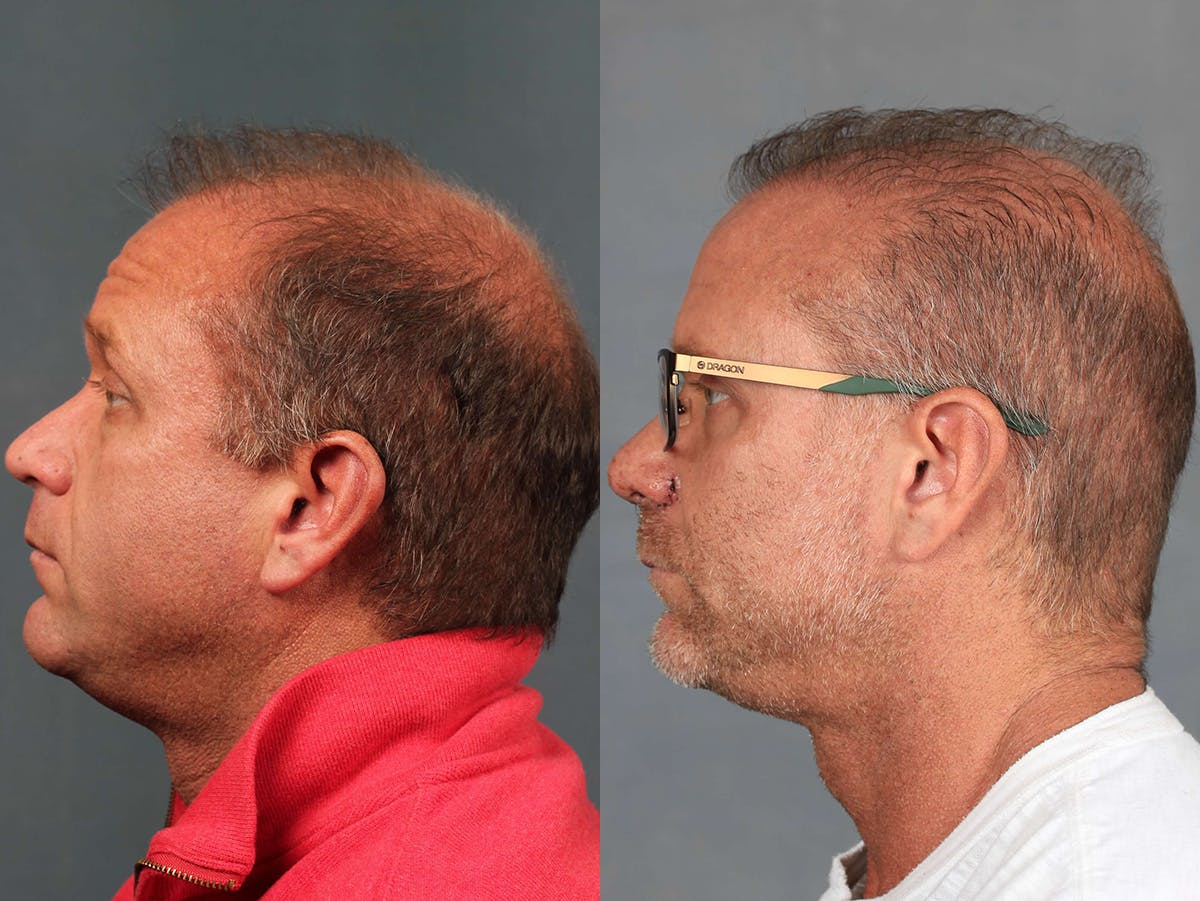 NeoGraft Before & After Gallery - Patient 214978 - Image 3