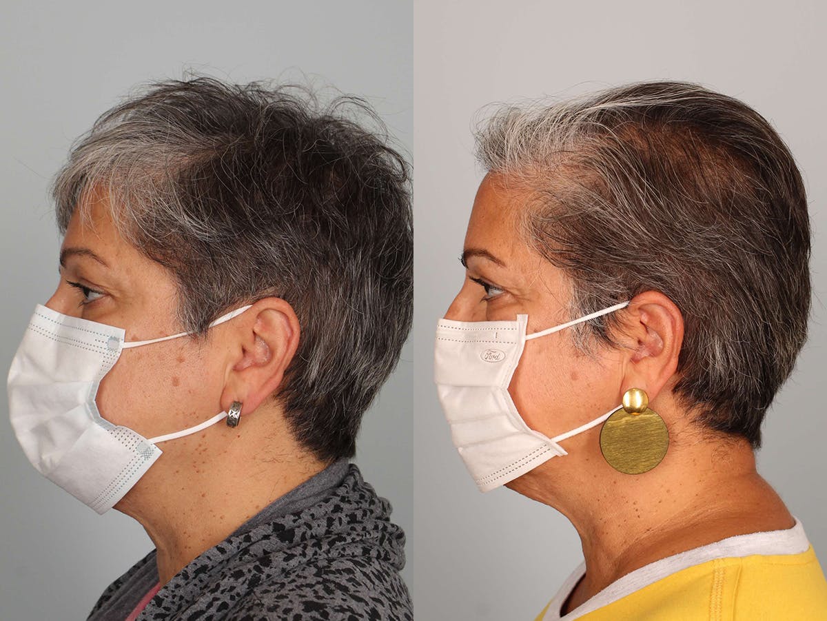 NeoGraft Before & After Gallery - Patient 403081 - Image 3