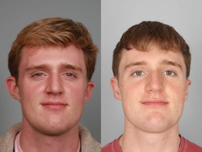 NeoGraft Before & After Gallery - Patient 338308 - Image 1