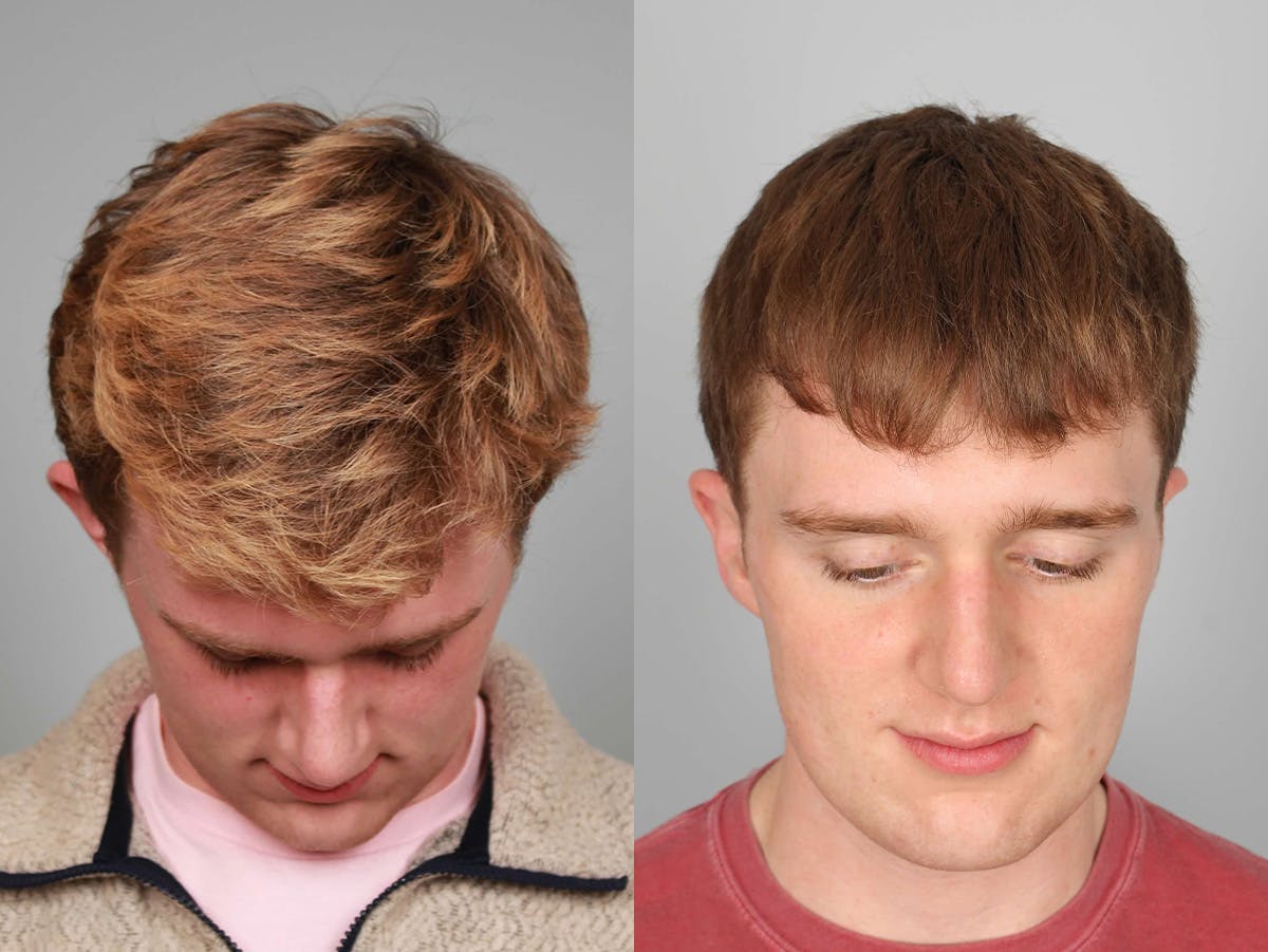 NeoGraft Before & After Gallery - Patient 338308 - Image 2