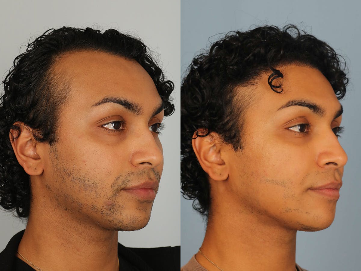 NeoGraft Before & After Gallery - Patient 523511 - Image 2