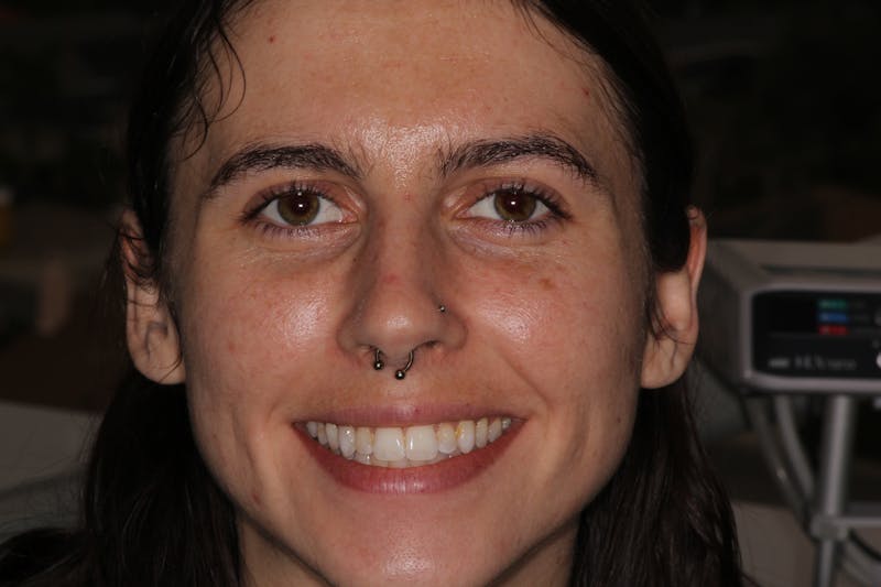 Ultra Thin Veneers Before & After Gallery - Patient 394907 - Image 1