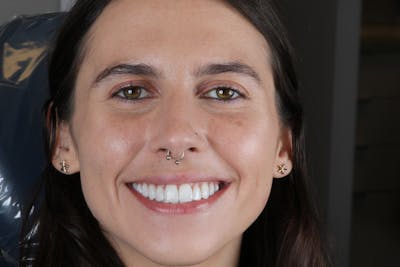 Ultra Thin Veneers Before & After Gallery - Patient 394907 - Image 2