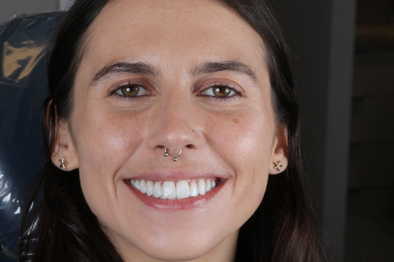 Ultra Thin Veneers Before & After Gallery - Patient 394907 - Image 2