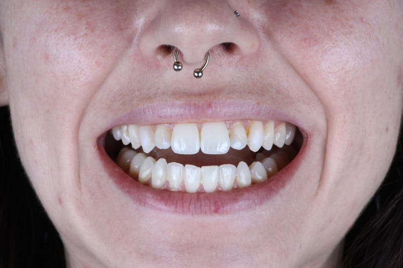 Ultra Thin Veneers Before & After Gallery - Patient 394907 - Image 3