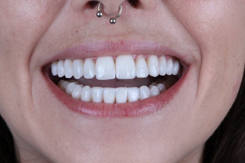 Ultra Thin Veneers Before & After Gallery - Patient 394907 - Image 4