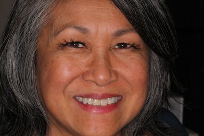 Ultra Thin Veneers Before & After Gallery - Patient 409028 - Image 1