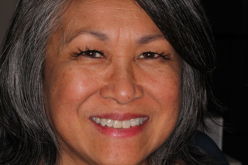 Ultra Thin Veneers Before & After Gallery - Patient 409028 - Image 1