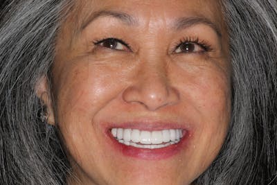 Ultra Thin Veneers Before & After Gallery - Patient 409028 - Image 2
