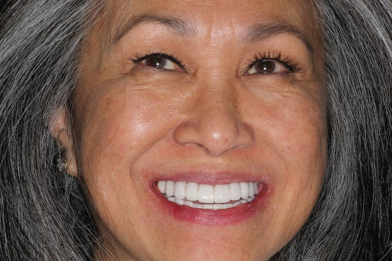 Ultra Thin Veneers Before & After Gallery - Patient 409028 - Image 2