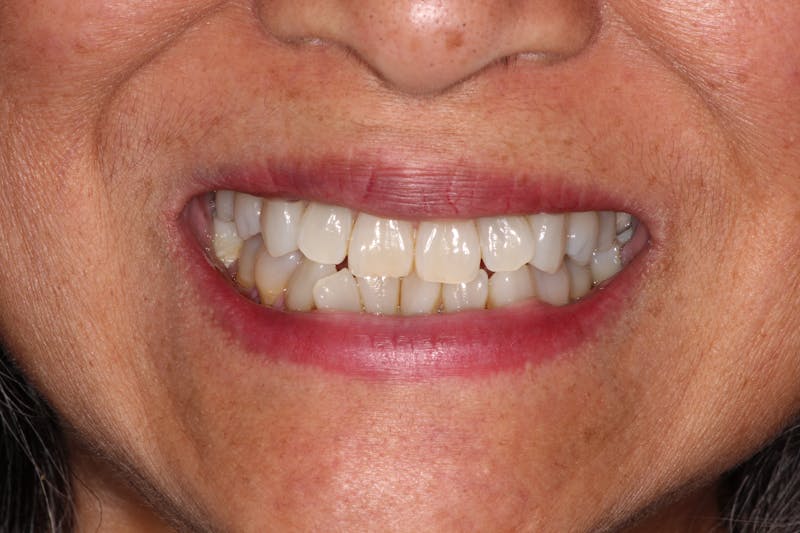 Ultra Thin Veneers Before & After Gallery - Patient 409028 - Image 3