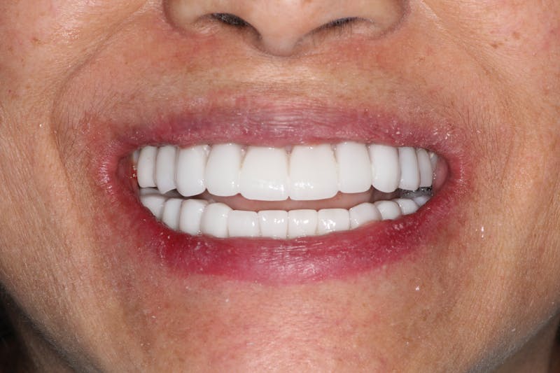 Ultra Thin Veneers Before & After Gallery - Patient 409028 - Image 4