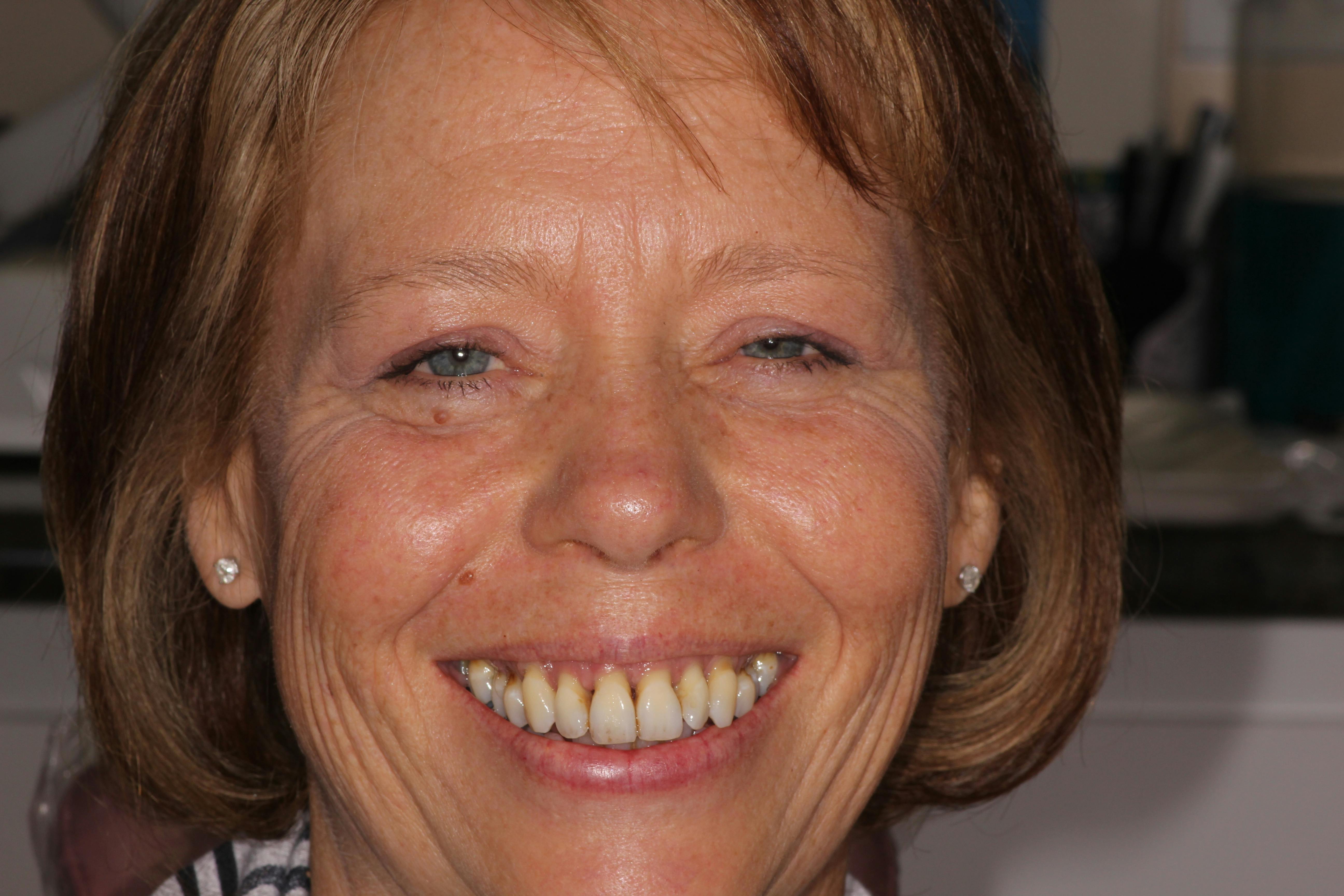 Before and After photos of Zirconia Dental Implants in Los Angeles and Encino