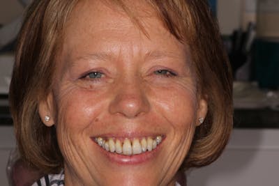 Dental Implants Before & After Gallery - Patient 354252 - Image 1