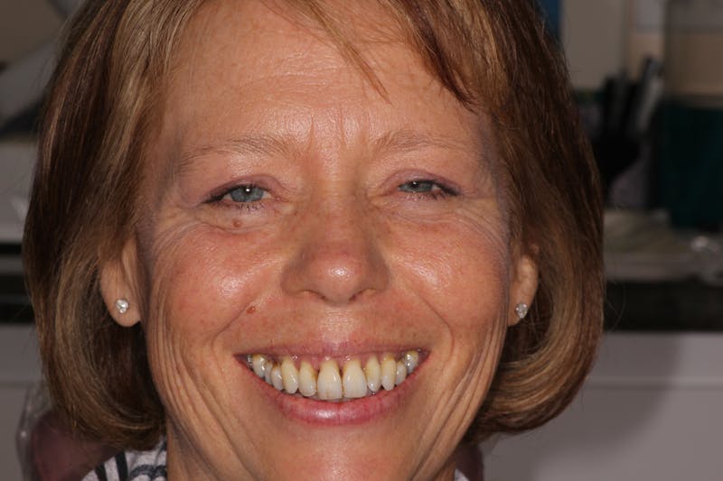 Dental Implants Before & After Gallery - Patient 354252 - Image 1