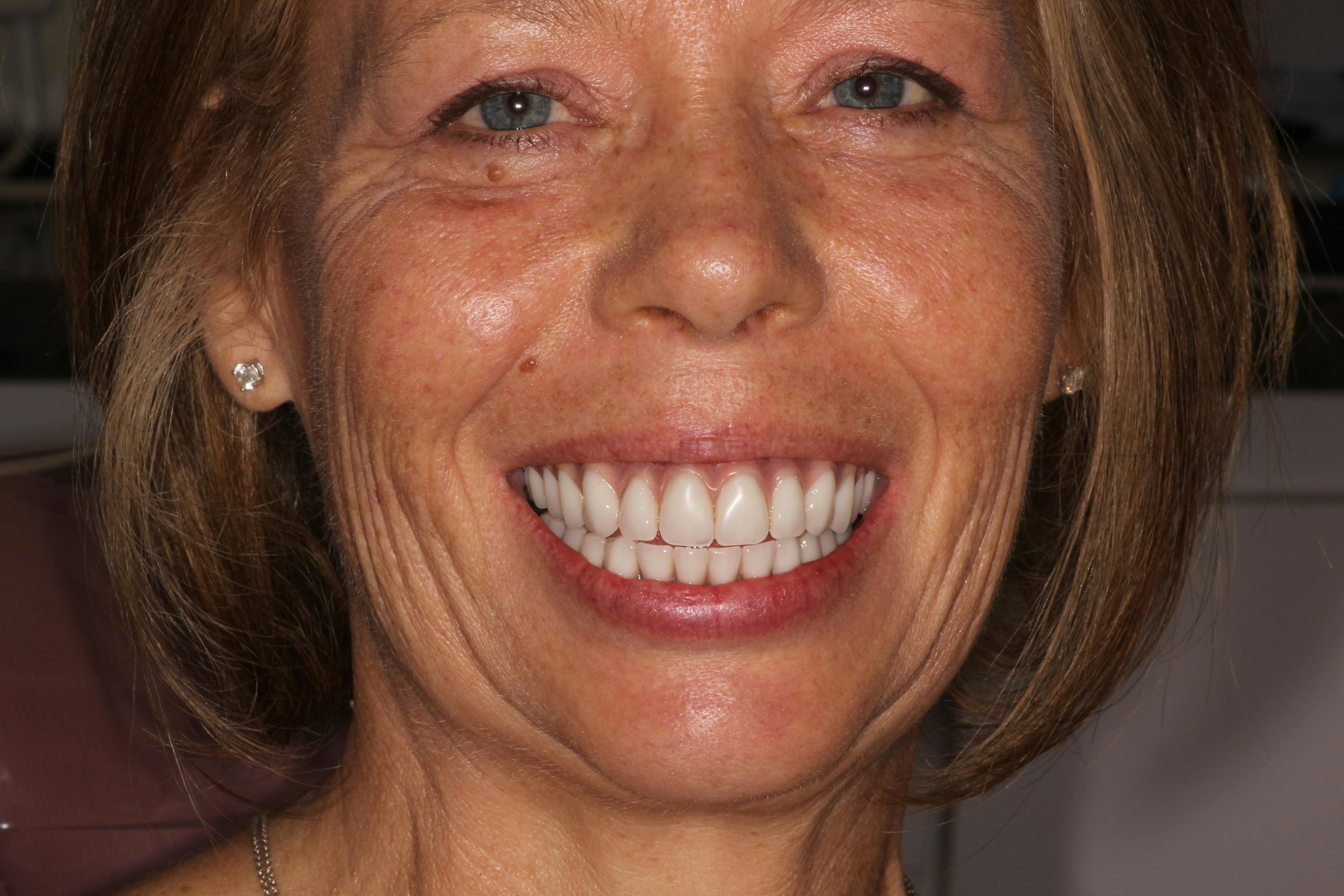 Before and After photos of Zirconia Dental Implants in Los Angeles and Encino