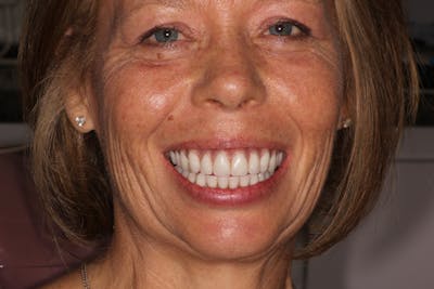 Dental Implants Before & After Gallery - Patient 354252 - Image 2