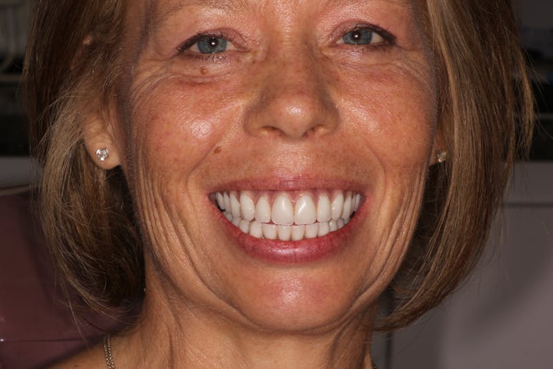 Dental Implants Before & After Gallery - Patient 354252 - Image 2