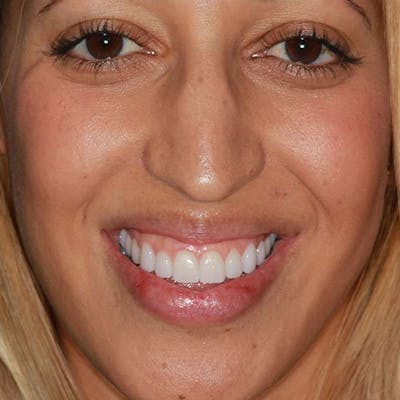 Ultra Thin Veneers Before & After Gallery - Patient 241017 - Image 2