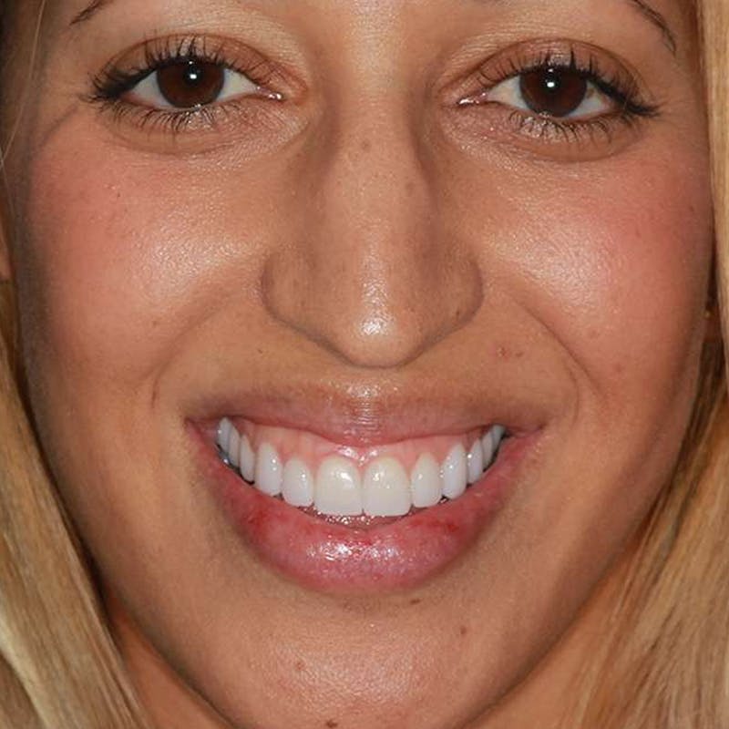 Ultra Thin Veneers Before & After Gallery - Patient 241017 - Image 2