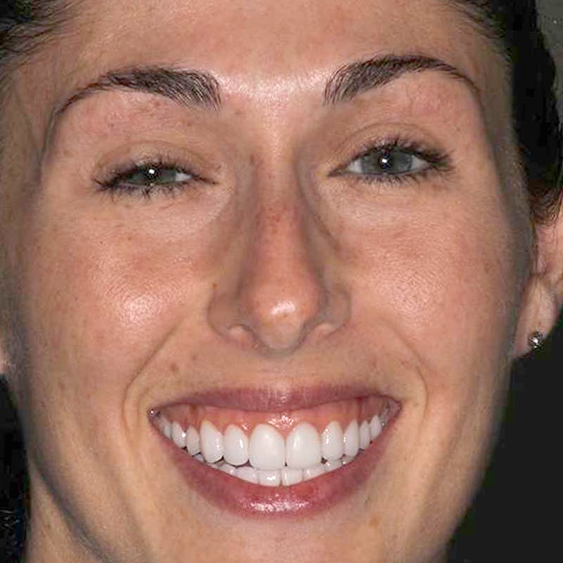 Ultra Thin Veneers Before & After Gallery - Patient 479602 - Image 2