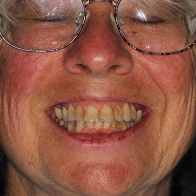 Ultra Thin Veneers Before & After Gallery - Patient 257290 - Image 1