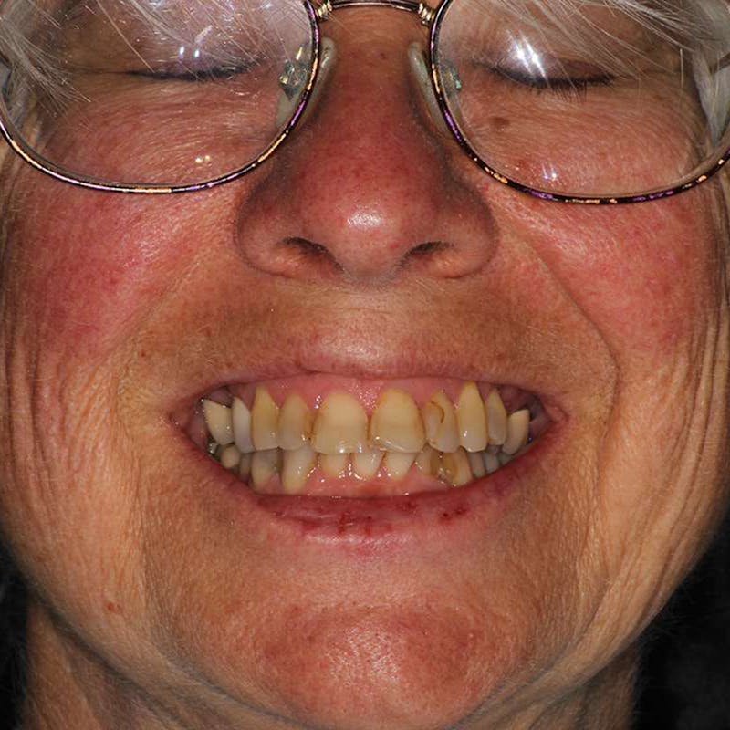 Ultra Thin Veneers Before & After Gallery - Patient 257290 - Image 1