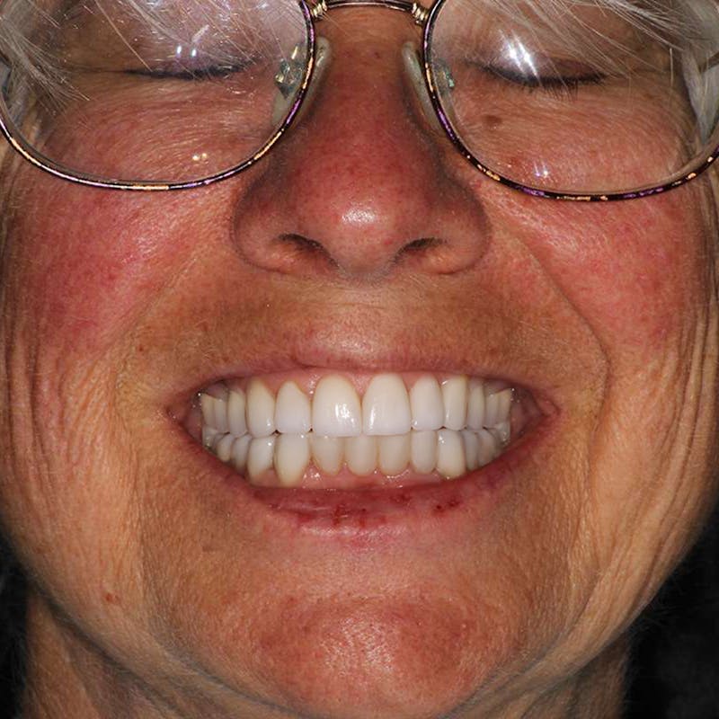 Ultra Thin Veneers Before & After Gallery - Patient 257290 - Image 2