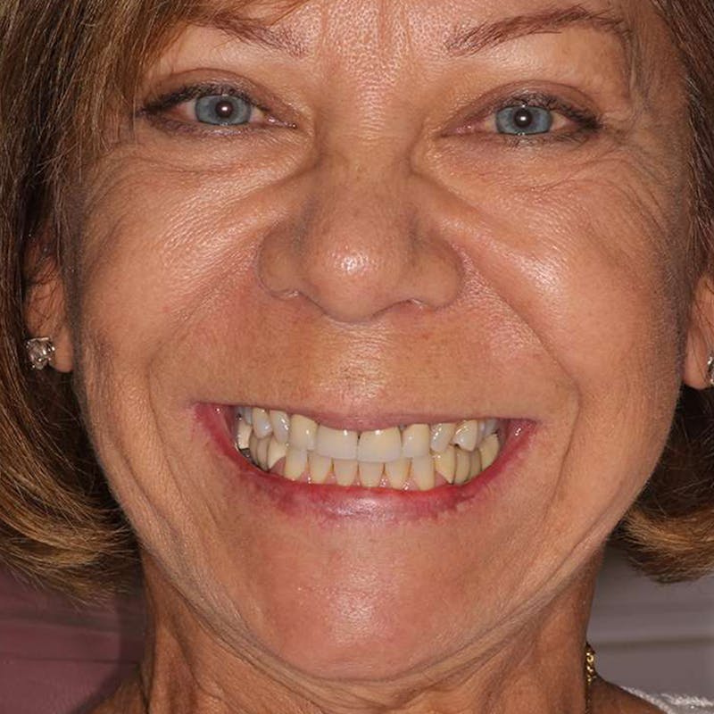 Ultra Thin Veneers Before & After Gallery - Patient 120136 - Image 1