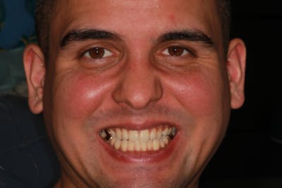 Ultra Thin Veneers Before & After Gallery - Patient 124056 - Image 1