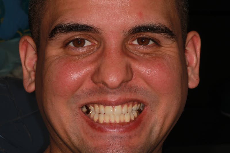 Ultra Thin Veneers Before & After Gallery - Patient 124056 - Image 1