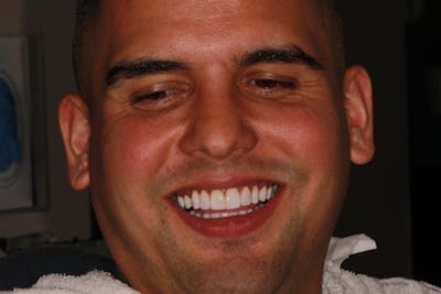 Ultra Thin Veneers Before & After Gallery - Patient 124056 - Image 2